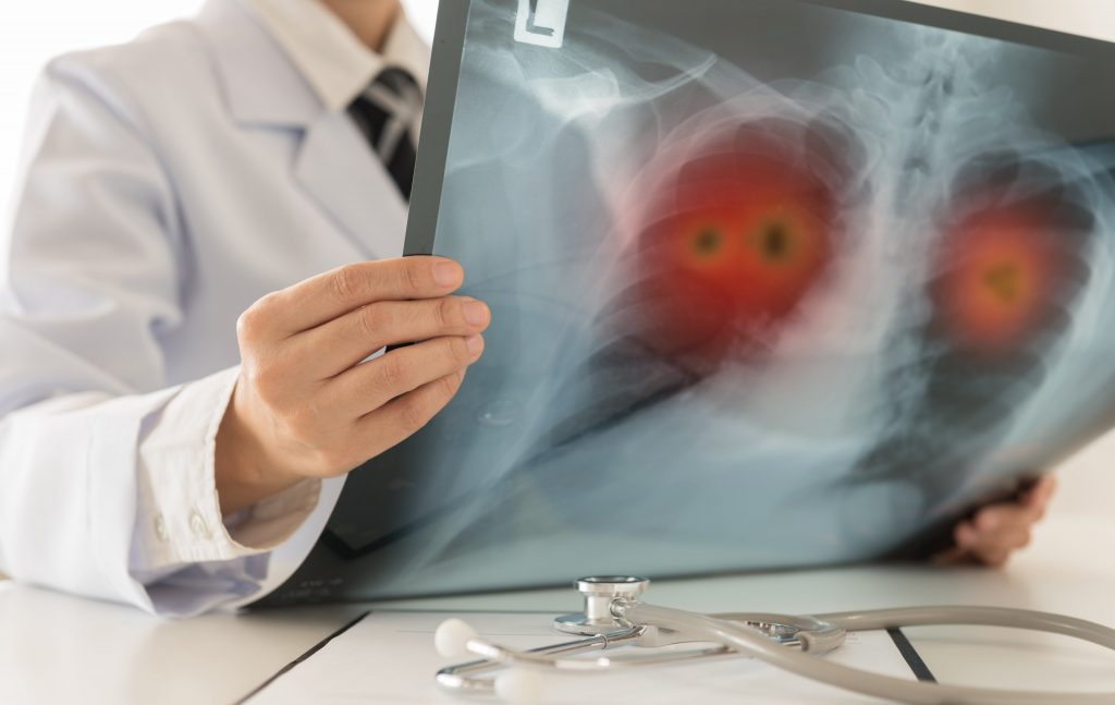 Doctor looking at an x-ray of a pair of blackened lungs