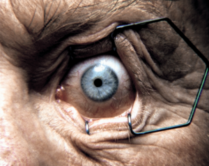 Image of someone's eye held open with a speculum