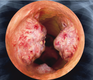 Anatomical image of lung cancer tumour