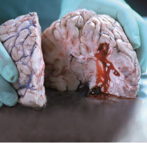 The brain of a stroke victim cut in half to show a blood clot