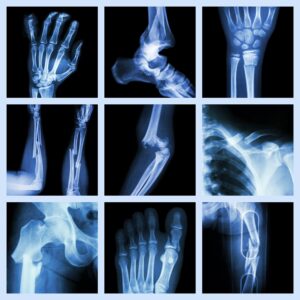 Collage of nine x-ray images featuring different fractured bones